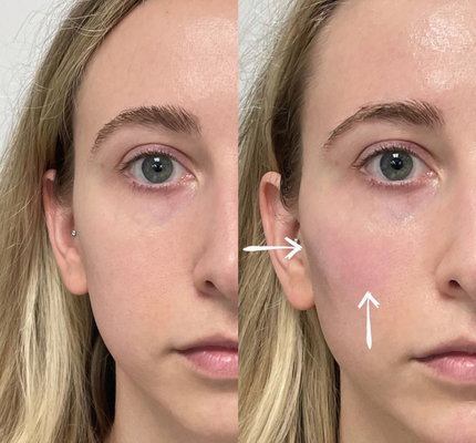Skinject Deep Hialuronic Acid Dermal 2ml Lips Fillers Injectable