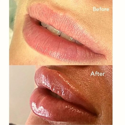 Injectable Filler Injection Juvederms Ultra 3 HA Dermal Filler do objętości ust