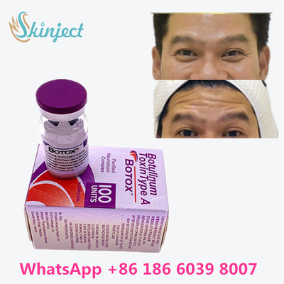 Toksyna Botulinowa Anti Aging Allergan  On Line Kup Przeciw Zmarszczkom