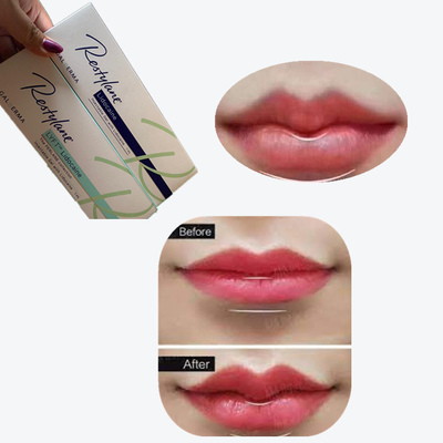2*1 ml/ pudełko Filler skórny z kwasem hialuronowym do powiększania warg