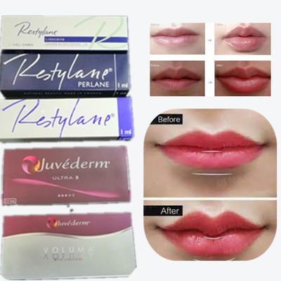 2*1 ml/ pudełko Filler skórny z kwasem hialuronowym do powiększania warg