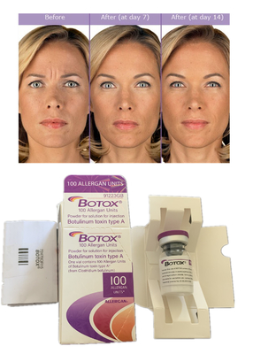 Allergan Botulax  Toksyna botulinowa 100JU Wypełniacz skórny przeciwzmarszczkom