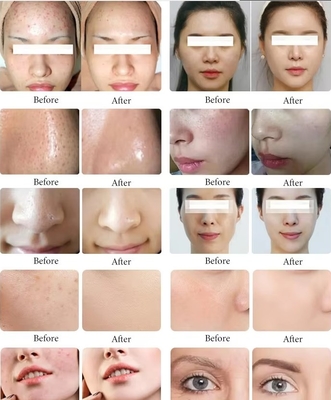 Black Pearl Skin Eye Management Hydrogen Oxygen Bubble Skin Cleansing Moisturizing Beauty Machine