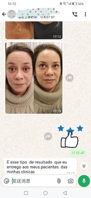 Kup 1 fiolkę Dysport 500iu  Toxins Injection For Face