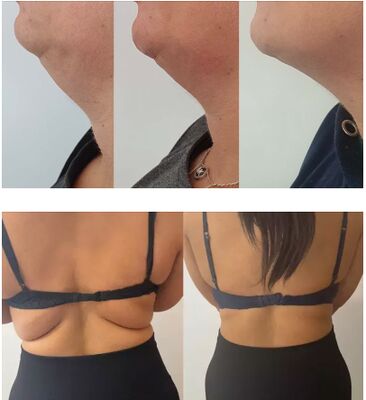 Lemon Bottle zastrzyki rozpuszczające tłuszcz Roztwór lipolityczny