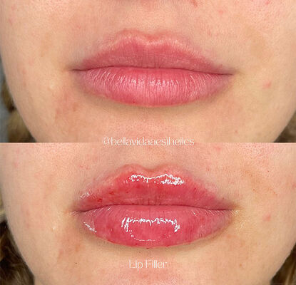 Okres przydatności do użycia 2 lata, wypełniacz skórny w żelu iniekcyjnym przeznaczony do redukcji zmarszczek, konturowania twarzy i rewitalizacji skóry