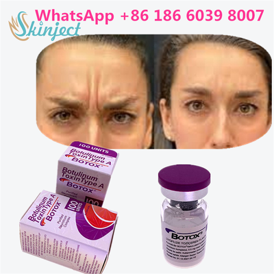 Toksyna botulinowa BOTOX Cosmetic 100 jednostek Allergan OnabotulinumtoxinA na zmarszczki mimiczne