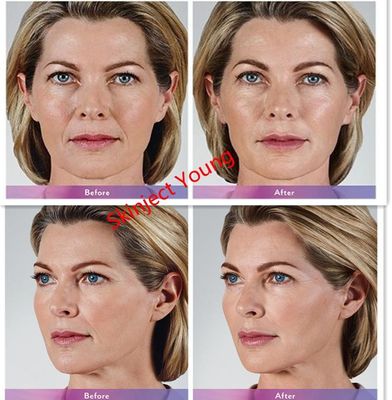 Juvederm Voluma 2x1ml Wypełniacze żelowe z kwasem hialuronowym do wstrzykiwań