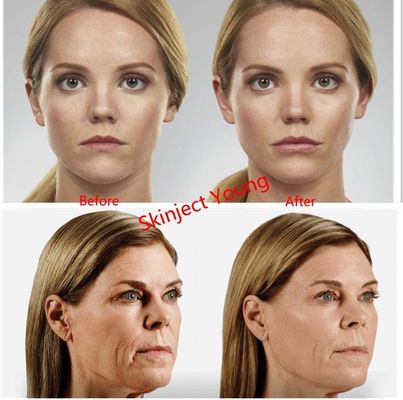 Juvederm Voluma 2x1ml Wypełniacze żelowe z kwasem hialuronowym do wstrzykiwań