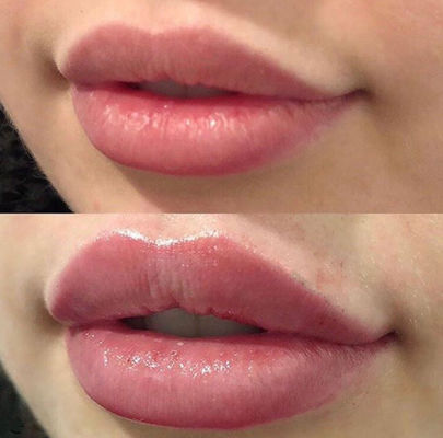 Russian Lips Juvederm Ultra 3 z krzyżowym wypełniaczem skórnym z lidokainą