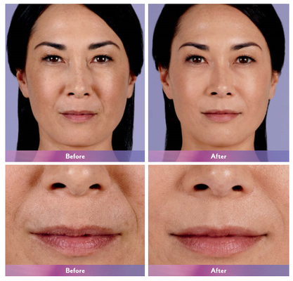 Juvederm Dermal Filler Lip Injection Ultra 4 do powiększania ust