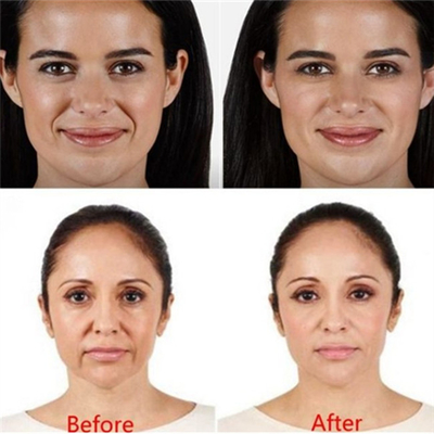 Wypełniacz do twarzy z kwasem hialuronowym Juvederm Voluma Hyaluronidaza Injection