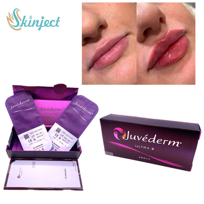 Fałdy nosowo-wargowe Usta 2x1ml Wypełniacz skórny Kwas hialuronowy Juvederm Ultra3