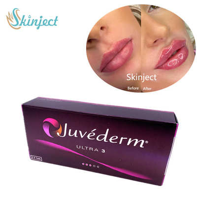 Juvederm Ultra3 2x1ml Wypełniacze do twarzy z kwasem hialuronowym przez skórę