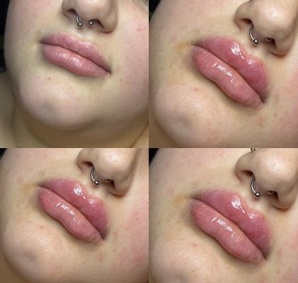 Revolax Deep HA Dermal Filler Lip Injections Ce Marked