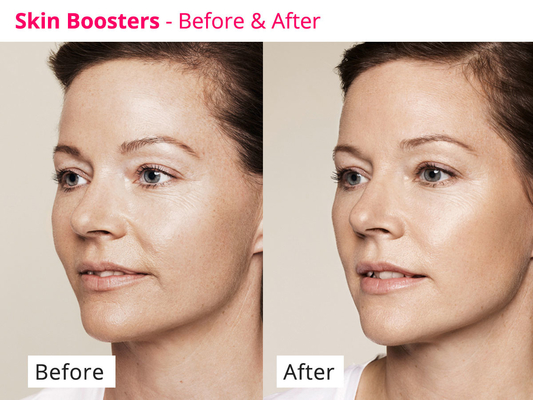 Odmładzające skórę PDRN Skinbooster Meso Serum do regeneracji kolagenu