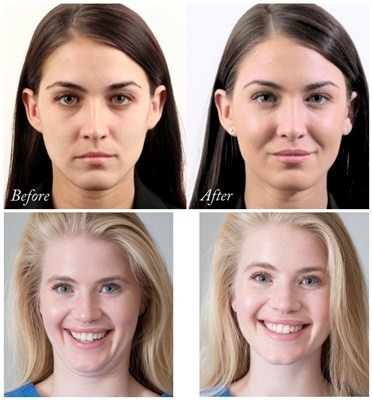 Ulepsz Juvederm Voluma Kwas Hialuronowy Wypełniacz do Twarzy 24 Mg/Ml