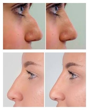 Juvederms Voluma Kwas hialuronowy wypełniacz do twarzy do powiększania podbródka i policzków