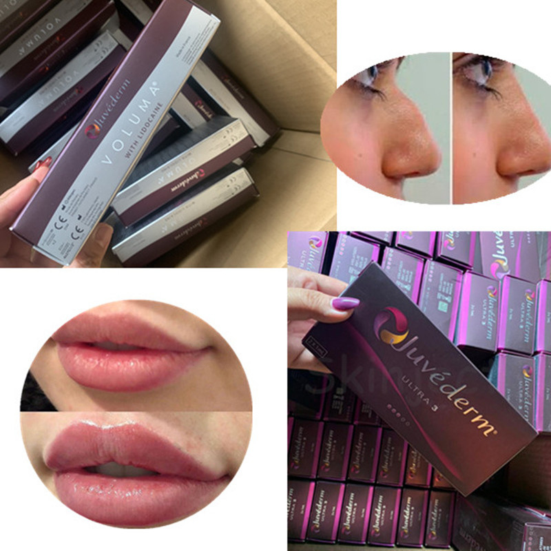 2 ml Juvederm Ultra 4 Wypełniacz skórny z kwasem hialuronowym do seksownych ust