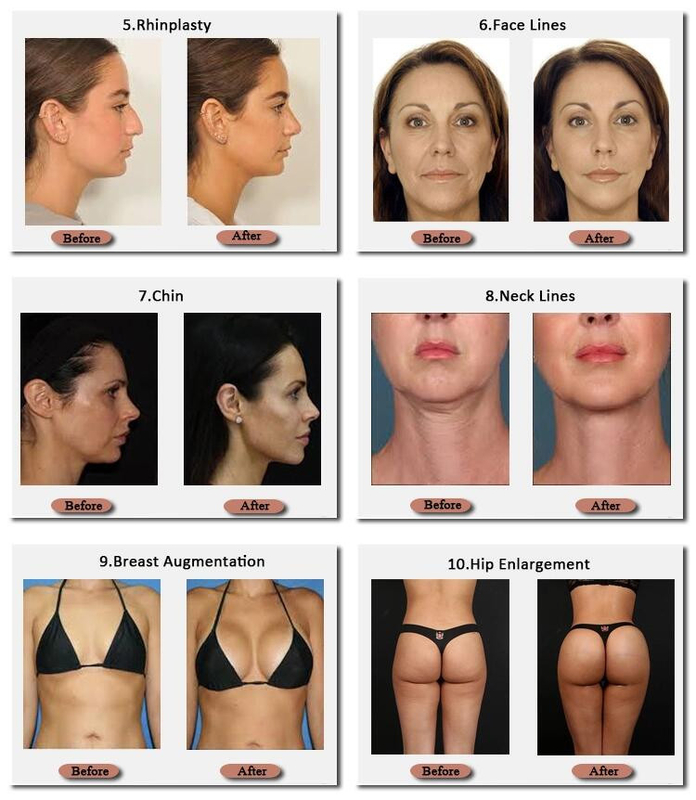 Skinjection 10 ml i 20 ml hialuronowy wypełniacz piersi Korean Technnology 24 mg/ml