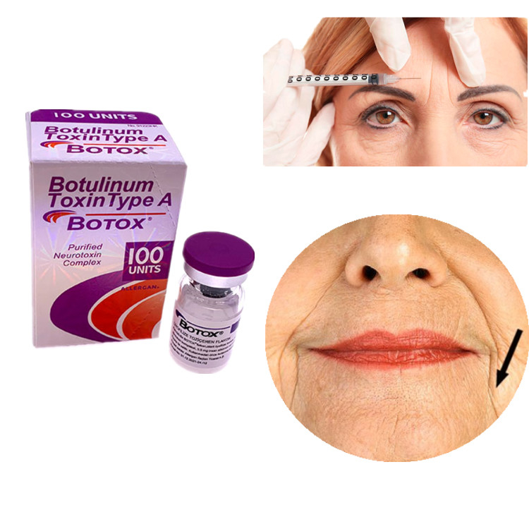Allergan Botox 100JU Toksyna botulinowa typu A na usunięcie zmarszczek twarzy i oczu