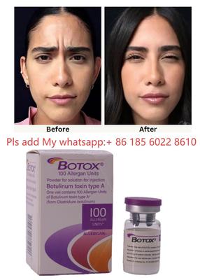 ALLERGAN Botox Iniekcja Toksyny Botulinowej Typu A